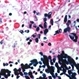 ARN : Zoster Intranuclear Inclusion Bodies
